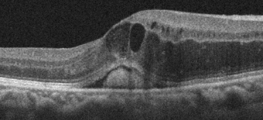 網膜静脈閉塞症，糖尿病黄斑浮腫に対する抗VEGF剤治療と視機能